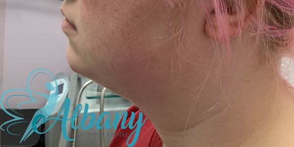 after injections