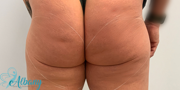 Cellfina Cellulite Treatment: Cost, Reviews, Treatment