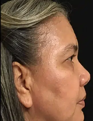 after chemical peel