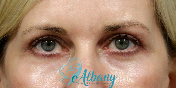 before and after eyelid tightening