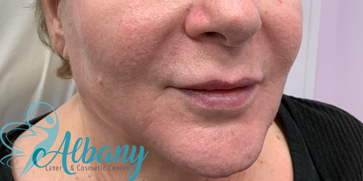 Close-up of a woman's face showing the right side after Bellafill fillers treatment at Albany Laser & Cosmetic Center, featuring smoother skin and reduced wrinkles.