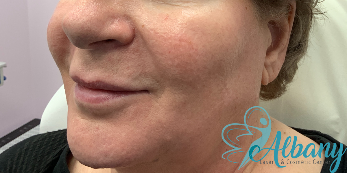 Close-up of a woman's face showing a left side view after Bellafill fillers treatment at Albany Laser & Cosmetic Center, demonstrating improved skin smoothness and diminished lines.
