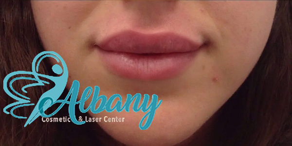 lip fillers after