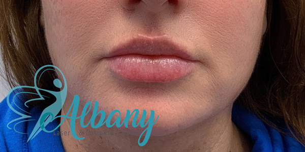 after lip injection edmonton