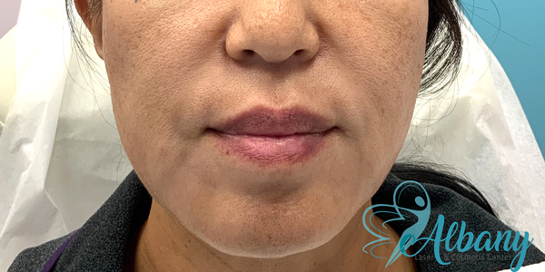 filler injection results