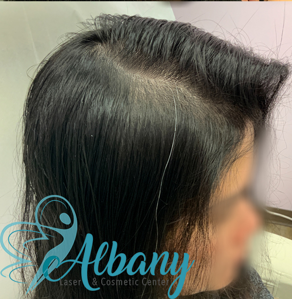 after prp hair loss injections edmonton