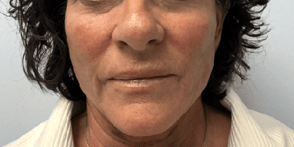 a picture of a female in her 60s after treatment at Albany Cosmetic and Laser Centre