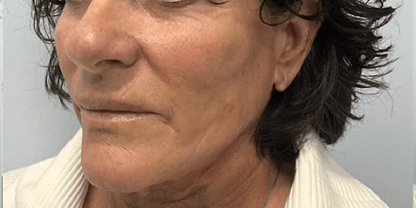 a picture of a female in her 60s after treatment at Albany Cosmetic and Laser Centre