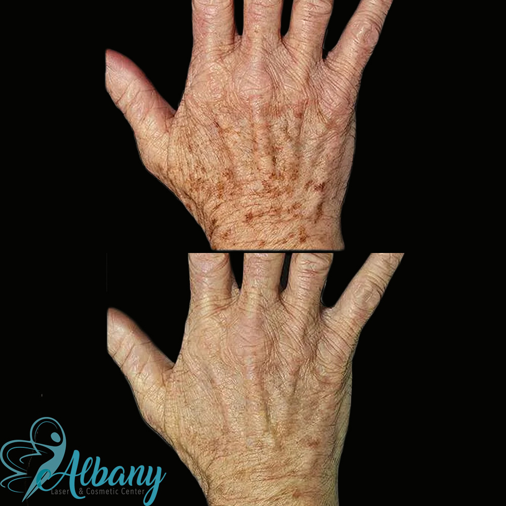 age spot treatment in st. albert