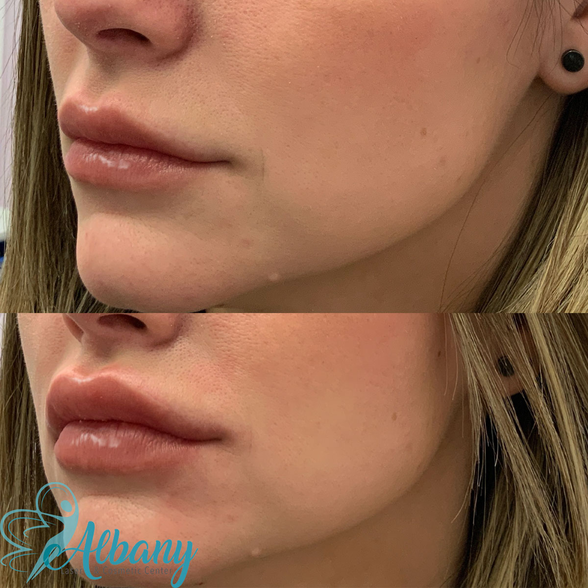 before and after lip fillers may 17