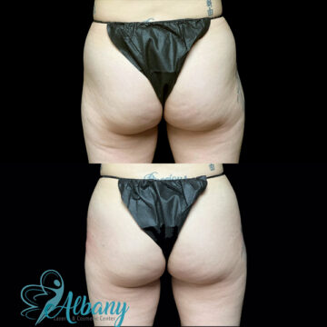 BBL brazilian butt lift