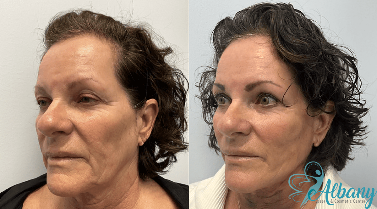 a picture showing showing a female in her 50s before and after receiving Sculptra in Edmonton