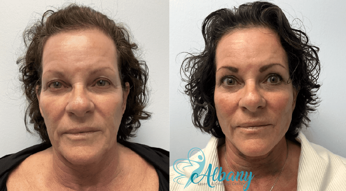 a picture showing showing a female in her 50s before and after receiving collagen Booster in Edmonton