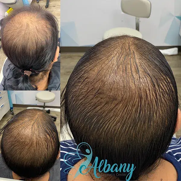 before and after PRP for hair