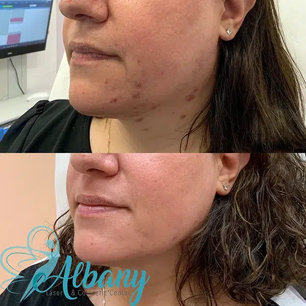 before and after acne treatment in Edmonton