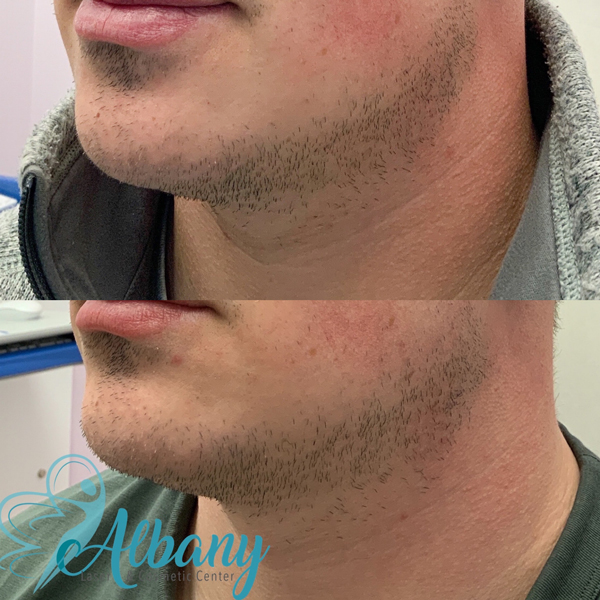 double chin reduction results