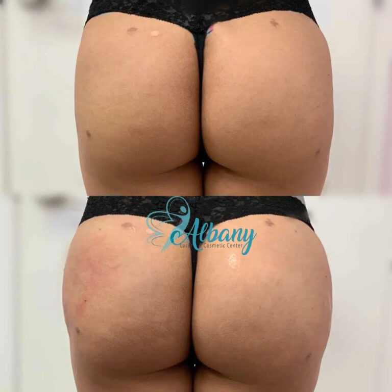 before and after brazilian butt lift