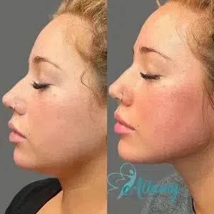 Comparison of a woman's side profile before and after cheek augmentation with fillers, showcasing subtle yet noticeable enhancement.