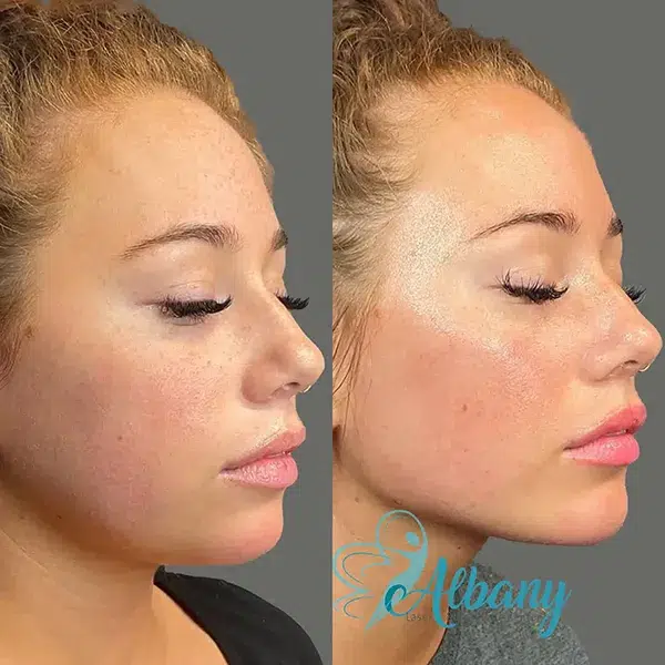 before and after cheek augmentation with fillers, showcasing subtle yet noticeable enhancement.