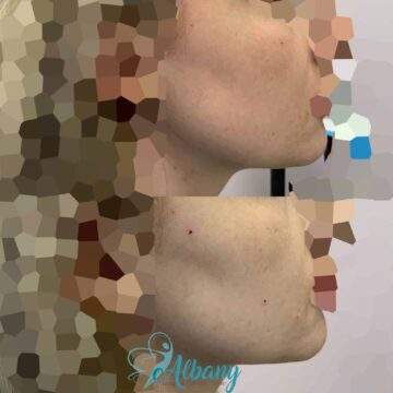 before and after cheek fillers