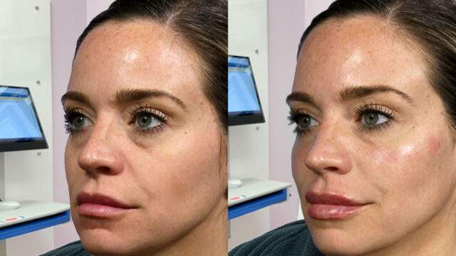 before and after cheek fillers