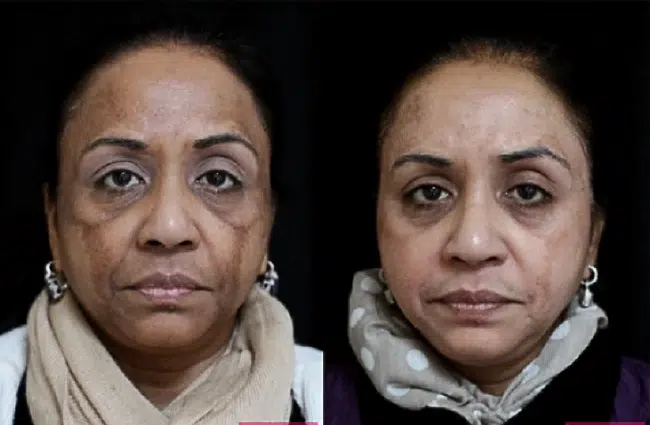 before and after chemical peel