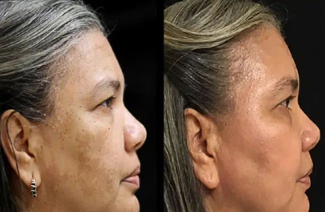 before and after chemical peel