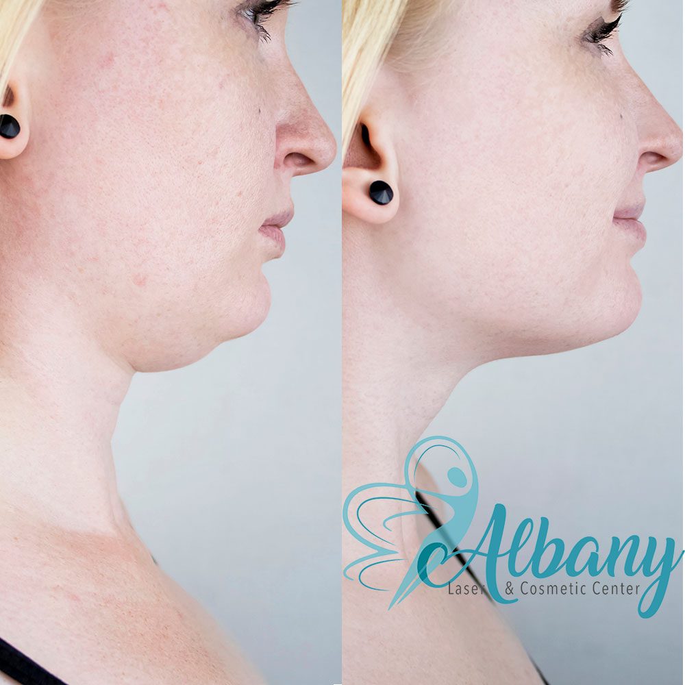 before and after coolmini treatment for double chin