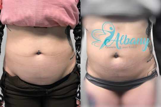 before and after coolsculpting