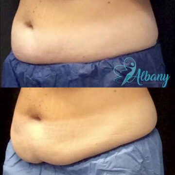 before and after coolsculpting