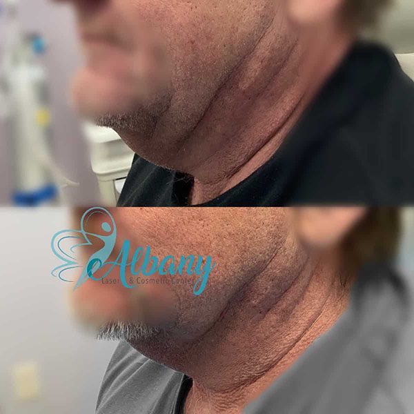 before and after double chin treatment