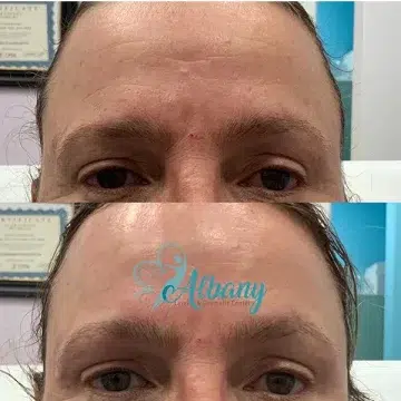 before and after eyebrow lift