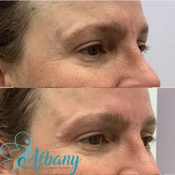 before and after eyebrow lift