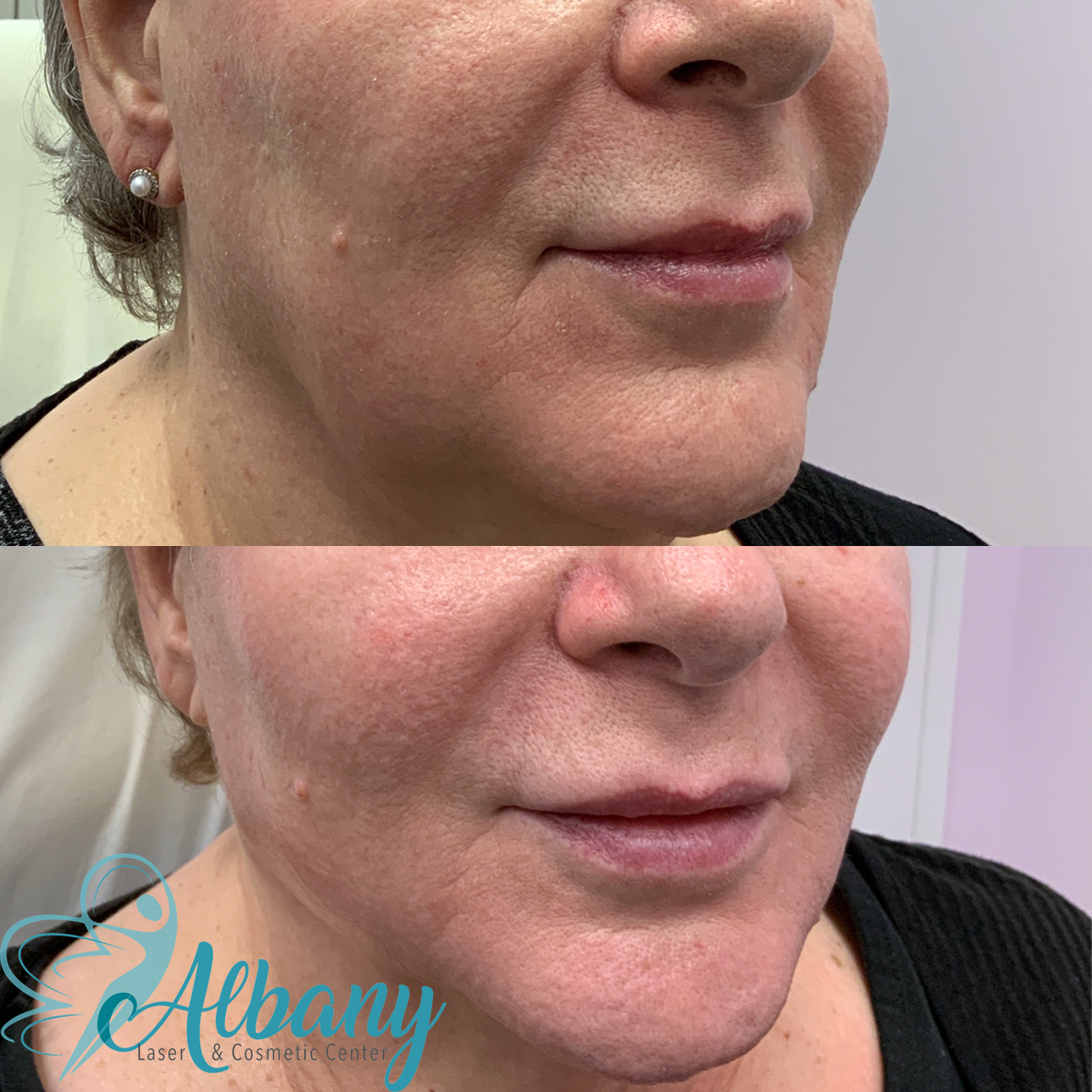 Before and after image of a woman's face showing the right side, demonstrating enhanced skin appearance and fewer wrinkles after Bellafill fillers treatment at Albany Laser & Cosmetic Center.