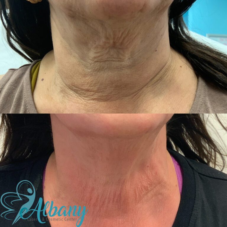 before and after fotona neck tightening