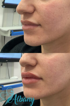 lip augmentation results