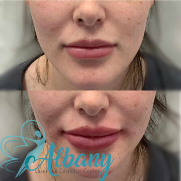 before and after lip fillers