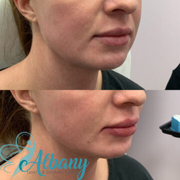 lip augmentation results