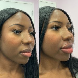before and after lip fillers at albany cosmetic and laser center in edmonton 2