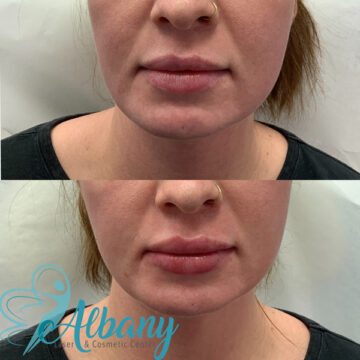 before and after lip injections