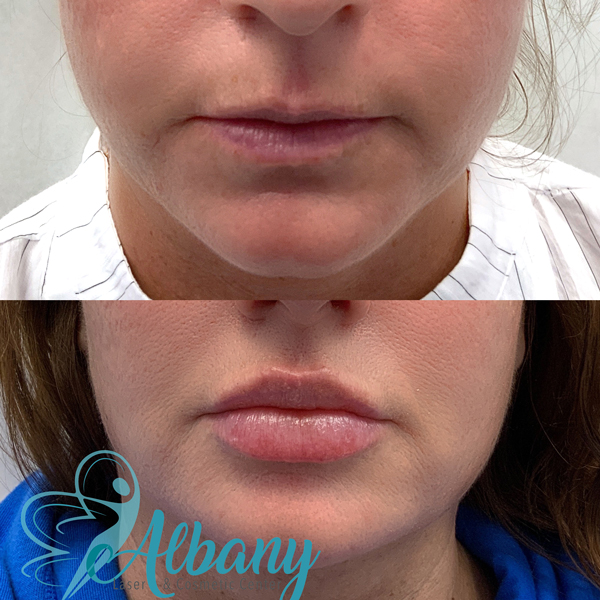 before after lip fillers St. Albert