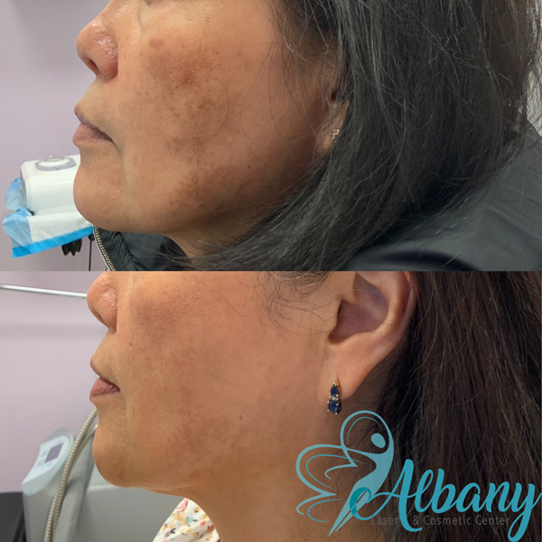 Hyperpigmentation treatment in Edmonton