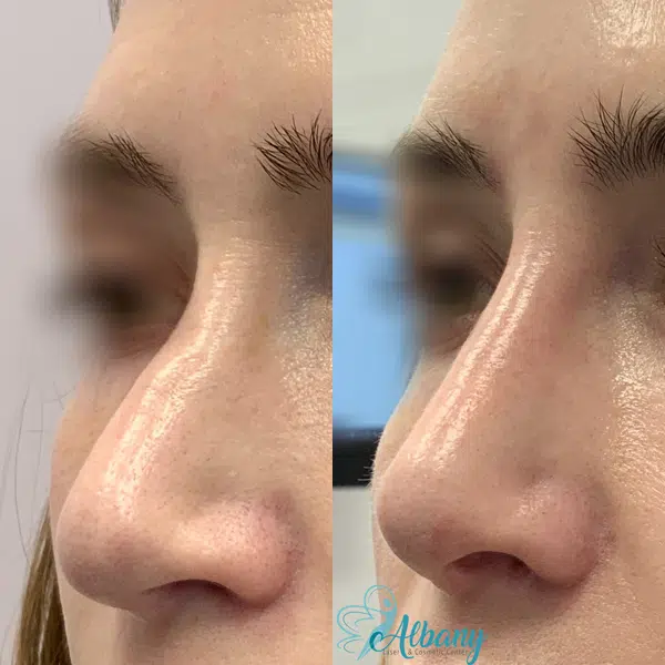 nose fillers results edmonton