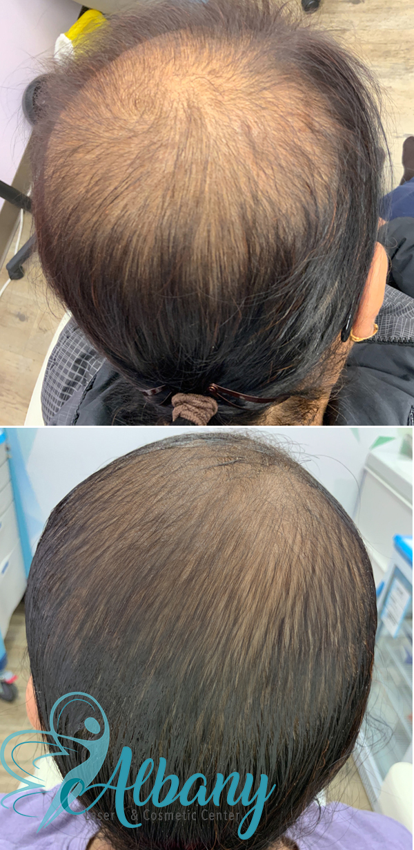 before and after hair restoration treatment edmonton