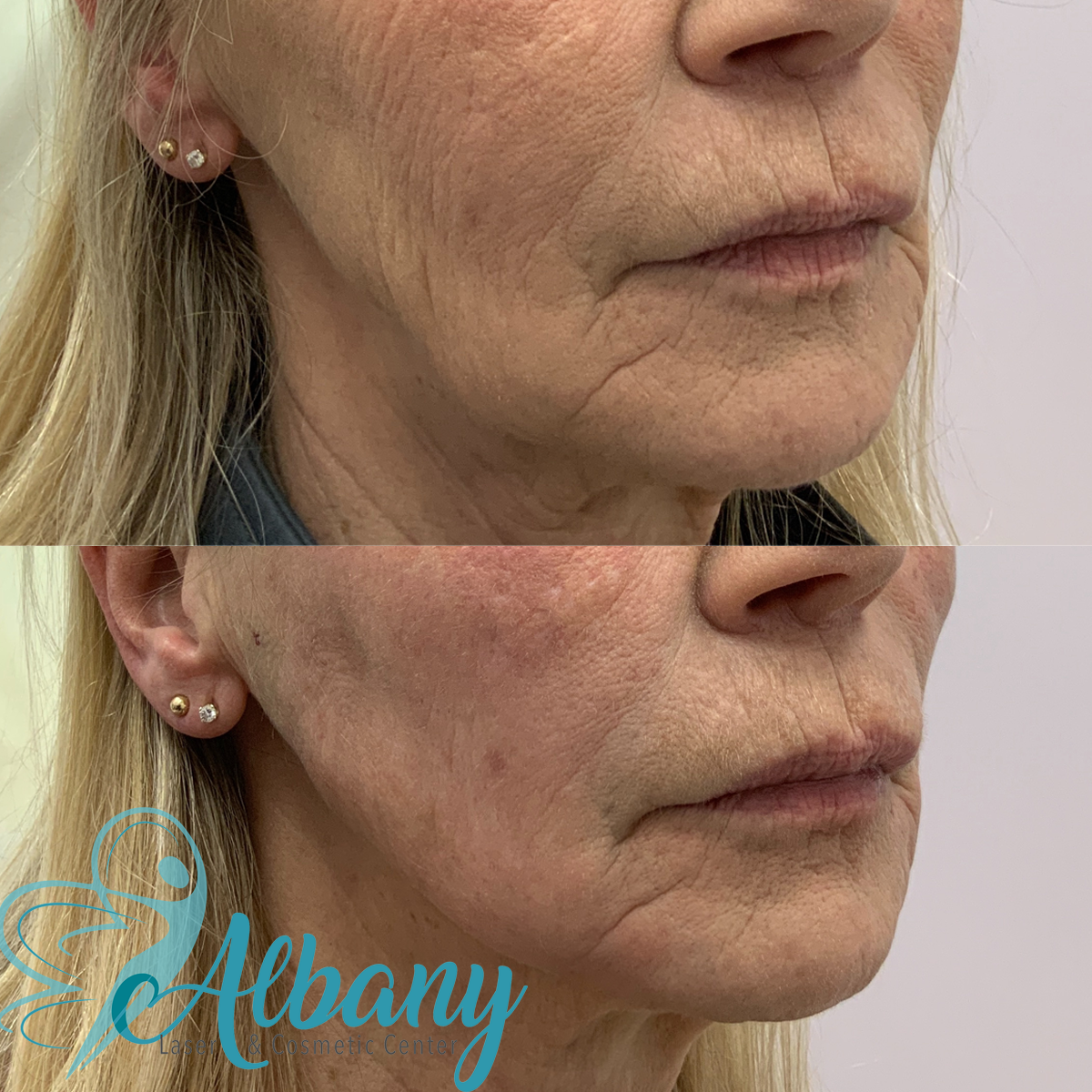 Close-up before and after images of a woman's lower face at Albany Laser & Cosmetic Center. The before image shows wrinkles and sagging skin around the mouth and jawline, while the after image reveals smoother and tighter skin.