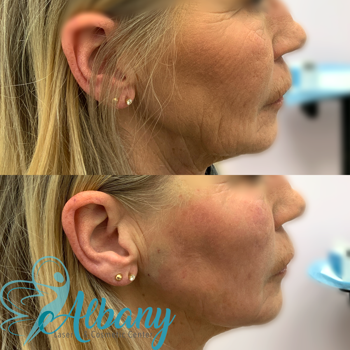 Before and after comparison of a woman's lower face, highlighting the effects of a cosmetic procedure performed at Albany Laser & Cosmetic Center. The before image shows visible wrinkles and sagging skin around the jawline and cheek. The after image shows a noticeable reduction in wrinkles and a firmer, more youthful appearance of the skin.
