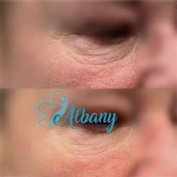 Before and after undereye fillers