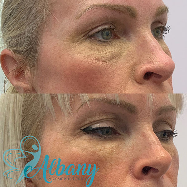 result undereye fillers