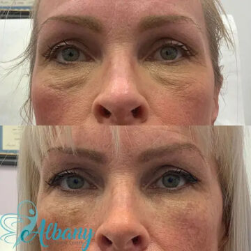 before and after undereye fillers