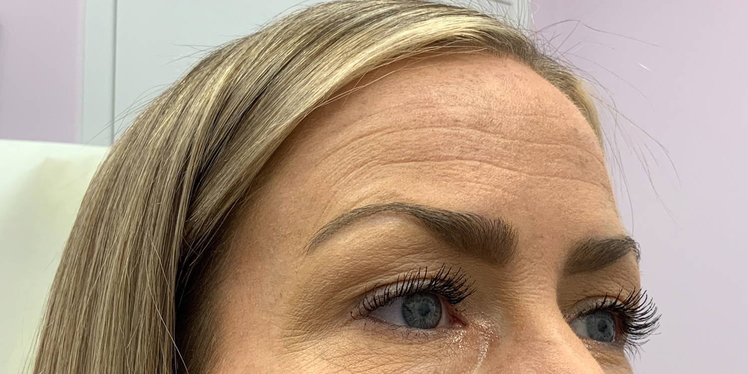 Before Botox Treatment for forehead lines